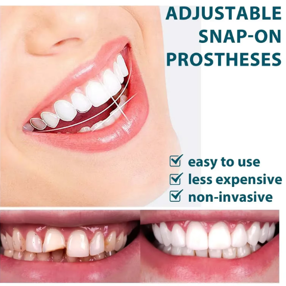 Smile Fit Flex - Removable Natural Dental Veneers (Upper and Lower)