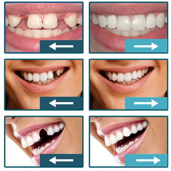 Smile Fit Flex - Removable Natural Dental Veneers (Upper and Lower)