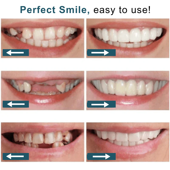 Smile Fit Flex - Removable Natural Dental Veneers (Upper and Lower)